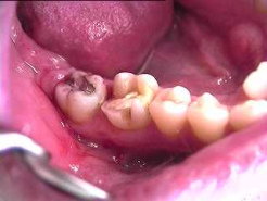 Backenzhne mit
                            Amalgam. Das Quecksilber dringt in die
                            Zahnsubstanz hinein und von dort weiter in
                            den Kieferknochen, denn Zhne sind nicht so
                            dicht, wie man allgemein meint