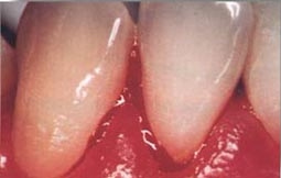 Zahnfleischbluten kann durch
                            eine Quecksilbervergiftung der
                            Mundschleimhaut durch Amalgam-Quecksilber
                            stark begnstigt sein und gefhrdet so die
                            Zhne