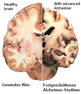Das
                          Alzheimerhirn hat gegenber dem normalen Hirn
                          einen grossen Teil der Substanz verloren