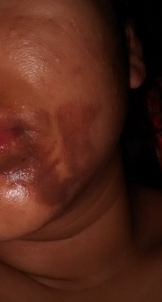 Verbrennungen und Akne im Gesicht