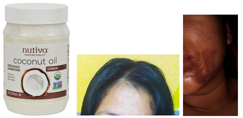 Kokosöl heilt die Haut, z.B. Akne
und Verbrennungen Kokosöl heilt die
Haut, z.B. Akne und Verbrennungen