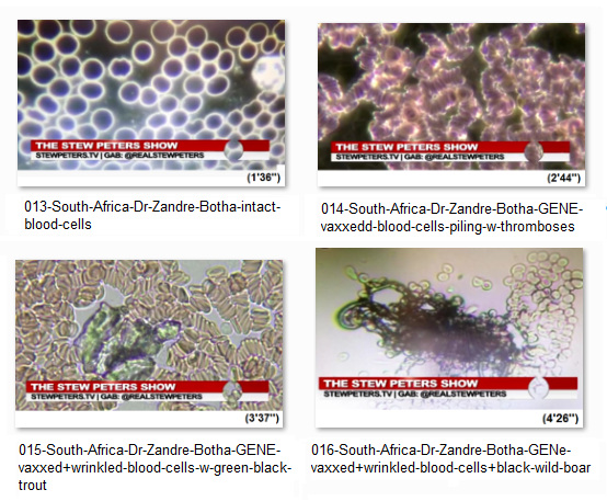 South Africa with Mrs. Dr. Botha:
                  comparison between intact blood cells and GENE vaxxed
                  wrinkled blood cells with objects in it like a trout
                  or a wild boar