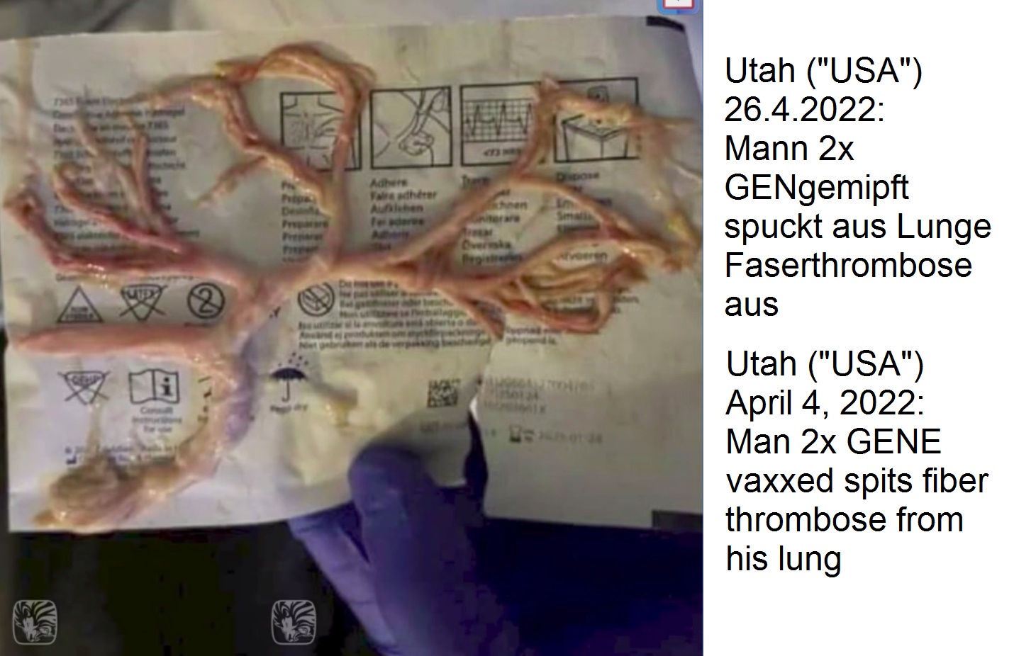 GENimpfschaden Utah ("USA")
                    27.4.2022: Mann (36) 2x GENgemipft hat
                    Faserthrombose in Form der Lungenwege ausgehustet