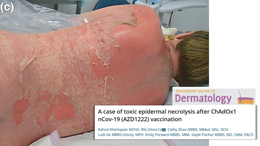 SCHLANGENGIFTimpfschaden ohne
                  Ort 6.9.2022: Foto Haut am Rücken weg: Epidermische
                  Nekrolyse (Hautauflösung)