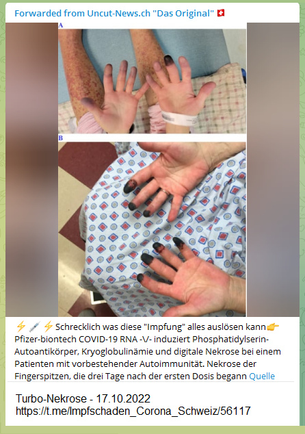 SCHLANGENGIFTimpfschaden ohne Ort 17.10.2022:
                    Turbo-Nekrosis an den Fingern - schwarze Finger