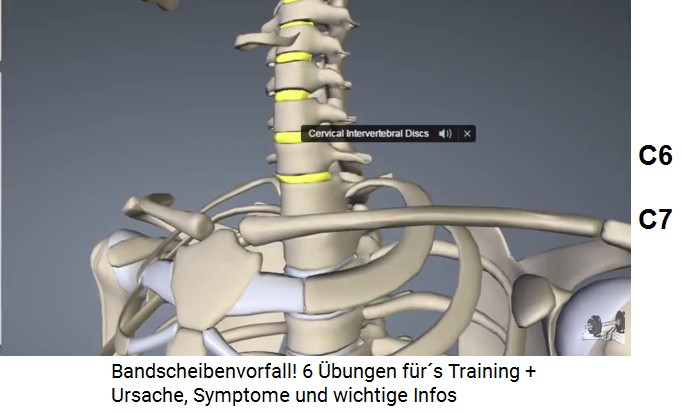 Die Halswirbel C6 und C7, Schema