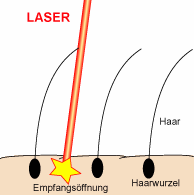 Loch durch
                            Laser