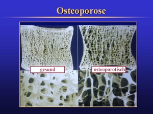 Knochen gesund und mit Knochenschwund
                            (Osteoporose) (01)