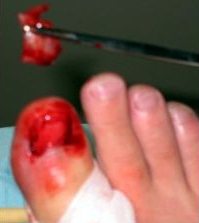 Die "Schulmedizin"
                            zieht bis heute Zehenngel und verletzt
                            dabei das gesamte Nagelbett