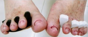 In der Klinik von Reiner
                  Niessen in Pattaya in Thailand werden Zehenngel mit
                  Przisionsinstrumenten abgeschliffen, ohne Schmerz und
                  zu niedrigen Kosten.