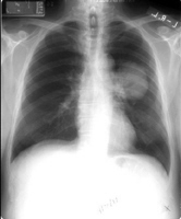 Rntgenfoto zeigt
                          Lungenkrebs