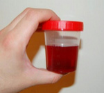 Blut im
                    Urin, roter Urin