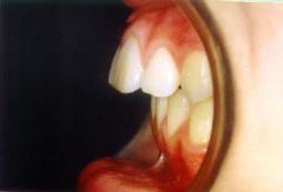Protrusin o sobre
                        mordida horizontal o dientes superiores salidos:
                        La mandbula no es bien formada, el maxilar
                        superior es mucho ms grande que la mandbula
                        [32]