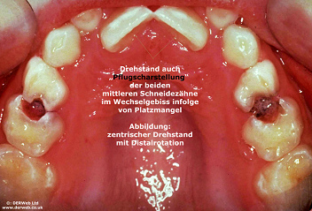 Cuando los dos
                        dientes incisivos frontales no tienen bastante
                        despacio, as salen muchas veces en una
                        "posicin girada cntrica", la
                        posicin llamada "posicin de reja".
                        Adems se ve en la foto muchas manchas blancas,
                        precursores de caries, y grandes caries entre
                        los dos premolares [13].