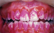 Aqu se ve un
                        segundo diente incisivo arriba al lado izquierdo
                        en una posicin girada "saliendo el arco
                        dental".