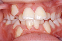 Apinamiento de los
                        dientes, una vista frontal: Un apinamiento de
                        los dientes va ser cuando el bebe solo recibe su
                        alimentacin por el bibern y as fue siempre
                        fcil a chupar. As eso no provoca un grande
                        crecimiento del maxilar. Ms tarde los dientes
                        no tienen bastante espacio [2] y la dentadura
                        parece a cereales [8].