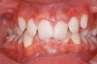 Malformacin dentaria Mordida cerrada
                          anterior (sobre mordida vertical profunda)