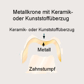 Corona: corona de metal y de cermica o
                          de plstico: eso es una corona de metal en el
                          raign dental con una capa de plstico o de
                          cermica [29], tambin llamada corona veneer
                          [37]