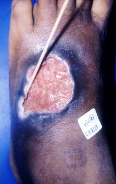 Carnivorous phageenic ulcer in Africa
