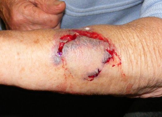 Herida grave en un brazo por un
                                    Pitbull