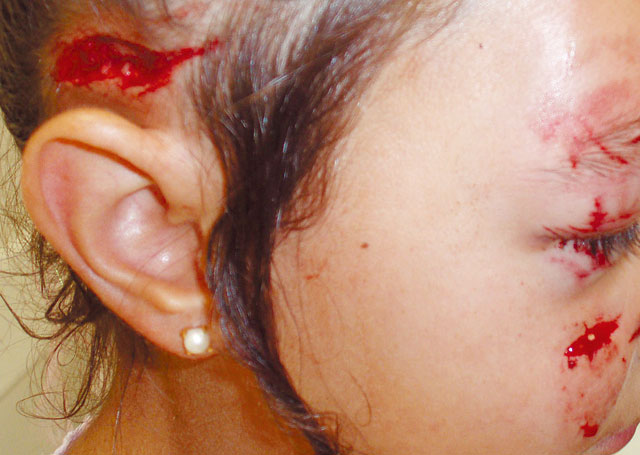 Heridas en la cara por un perro pastor
                          (02) [17] con una nia de 7 aos