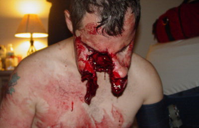 Heridas en la cara
                        por un perro de pelea Pitbull [19].