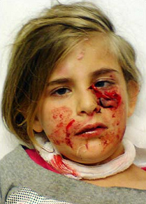 La hija Zoe Stenton (9 aos) de
                                    Castleford (Inglaterra) con las
                                    heridas en su rostro provocado por
                                    un perro agresivo mezclado de Akita
                                    y perro pastor [71]