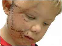 El nio George Brown de 4 aos
                                    atacado dos veces por el Bulldog del
                                    vecino en Cambridgeshire en
                                    Inglaterra