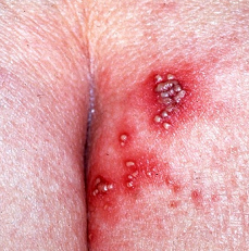 Genital herpes on the buttock (on the ass)