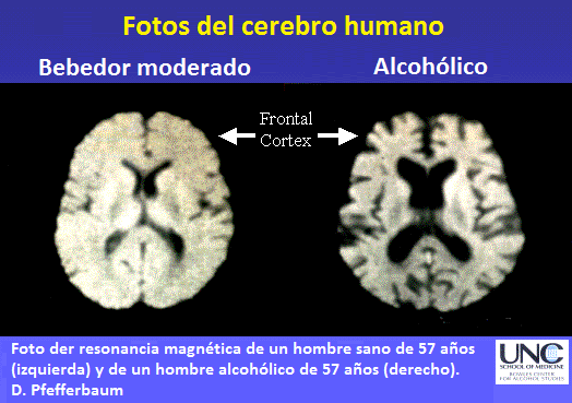 Magnetresonanz-Foto eines Alkoholiker-Hirns
                      mit grossen Lchern bei einem 57 Jahre alten
                      Alkoholiker