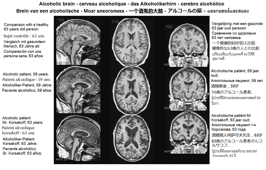 Grosse Lcher im Hirn und
                                  Zerstrung ganzer Hirnbereiche bei
                                  einem 57 und 63 Jahre alten
                                  Alkoholiker mit Vergleichsfoto