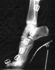 Ein Fuss in einem
                        High-Heel-Schuh, Rntgenfoto der deformierten
                        Fussstellung. Das Hauptgewicht liegt auf den
                        Zehenballen, und das ergibt einen schmerzhaften
                        Spreizfuss.