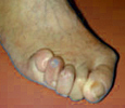 Fsse
                        werden durch Stckelschuhe (High-Heels)
                        systematisch in eine V-Vorm verstmmelt, zum
                        Beispiel so wie auf diesem Foto, wo alle vier
                        kleinen Zehen zu Hammerzehen verstmmelt wurden.
                        Stckelschuhe bzw. High-Heels sind somit der
                        absolute Sadismus und Masochismus.