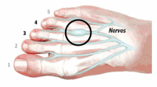 Das
                          Morton-Neurom (Knotenbildung im Nerv zwischen
                          dem dritten und vierten Strahl des
                          Mittelfussknochens) bringt Fussschmerzen und
                          eventuell Taubheit im Gefhl mit sich