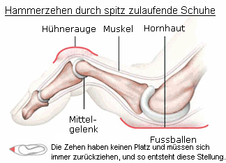 Hammerzehe, Schema: Die Zehen haben bei
                          spitz zulaufenden Schuhen keinen Platz und
                          mssen sich immer zurckziehen, und so
                          entsteht diese Krppelstellung, die
                          Hammerzehe.