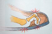 Darstellung eines Hammerzehs
                          (02): Hier sind das mittlere Glied und das
                          Endglied nach unten gerichtet, und
                          entsprechend sind zwei Zehengelenke berdehnt,
                          und am Zeh entwickeln sich gleich drei
                          Druckstellen mit Hhneraugen auf einmal.