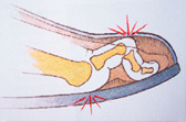 Krallenzehe, Schema mit Angabe der
                          Hornhautbildung (unten) und der Bildung von
                          Hhneraugen (oben)