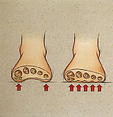 Schema der Entstehung eines Spreizfuss:
                          Die "Brcke" der Zehenballen ist
                          eingeknickt, und beim Laufen werden alle
                          Zehenballen belastet, mit viel Bildung von
                          Hornhaut, was normalerweise nicht der Fall
                          ist