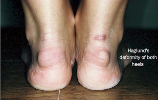 Haglund-Fersen, verursacht durch die
                          harten Fusskappen oder Schuhriemen der hohe
                          Stckelschuhe (High-Heels)
