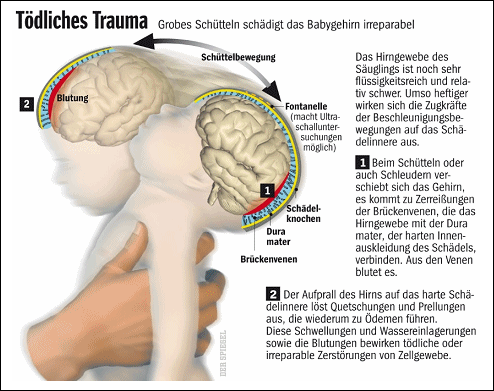 Schtteltrauma beim Baby, Schema: Das Hirn
                        hat noch viel Wasser und die Verletzungen sind
                        an beiden Seiten des Hirns