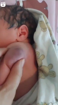 Impfschaden beim Baby ohne Ort am 9.12.2024:
geschwollene Impfstelle, so dick wie der Arm selber Impfschaden beim Baby ohne Ort am 9.12.2024:
geschwollene Impfstelle, so dick wie der Arm selber